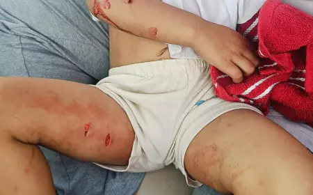 Greater Noida News : लावारिस कुत्तों ने बच्ची को काटा, हालत गंभीर